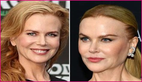 Nicole Kidman Face Lift: The Secrets Behind Her Ever-Youthful Appearance